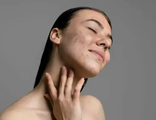 What Are The Best Treatments For Acne Scars?